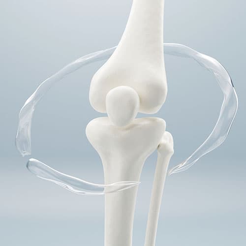 Artroplasti (Protez) Cerrahisi